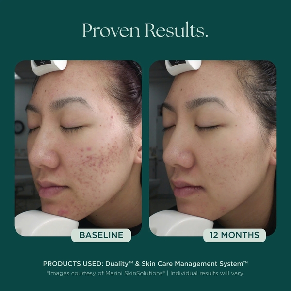 MARINI SKINSOLUTIONS Duality™ – Tinh Chất Hỗ Trợ Giảm Mụn Và Cải Thiện Dấu Hiệu Lão Hóa