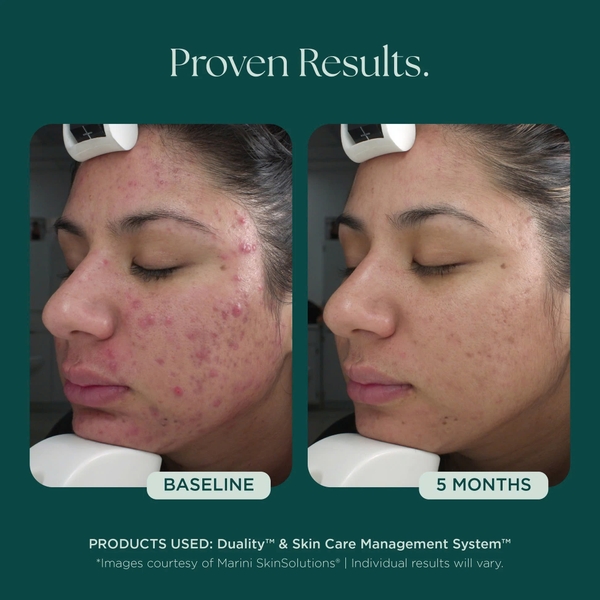 MARINI SKINSOLUTIONS Duality™ – Tinh Chất Hỗ Trợ Giảm Mụn Và Cải Thiện Dấu Hiệu Lão Hóa