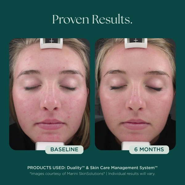 MARINI SKINSOLUTIONS Duality™ – Tinh Chất Hỗ Trợ Giảm Mụn Và Cải Thiện Dấu Hiệu Lão Hóa
