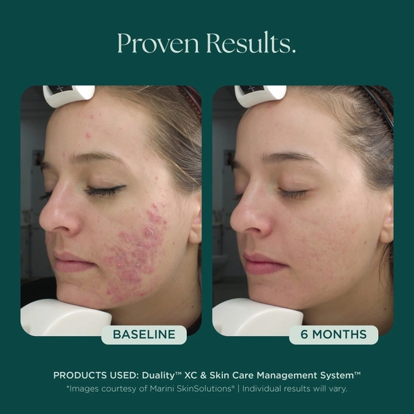 MARINI SKINSOLUTIONS Duality™ – Tinh Chất Hỗ Trợ Giảm Mụn Và Cải Thiện Dấu Hiệu Lão Hóa
