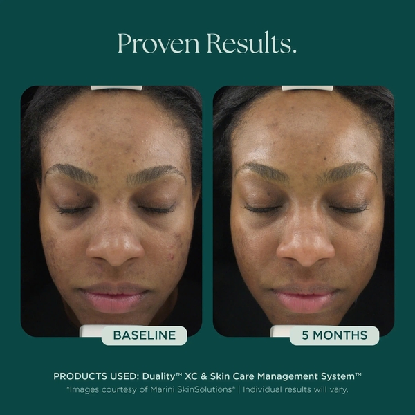 MARINI SKINSOLUTIONS Duality™ – Tinh Chất Hỗ Trợ Giảm Mụn Và Cải Thiện Dấu Hiệu Lão Hóa