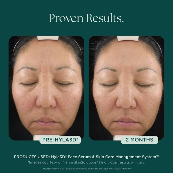 MARINI SKINSOLUTIONS Hyla3D® Face Serum – Tinh Chất Hyaluronic Acid Đa Tầng Hỗ Trợ Cấp Ẩm Và Giúp Da Trông Căng Đầy