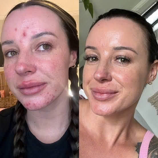 Elaine Brennan GetGlowing Micro-Peel – Liệu Trình Peel Chuyên Nghiệp Hỗ Trợ Làm Sáng Và Cải Thiện Bề Mặt Da