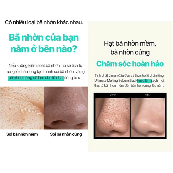 Temp31 Ultimate Melting Sebum Blackhead – Tinh Chất Ủ Làm Sạch Mụn Đầu Đen Và Bã Nhờn