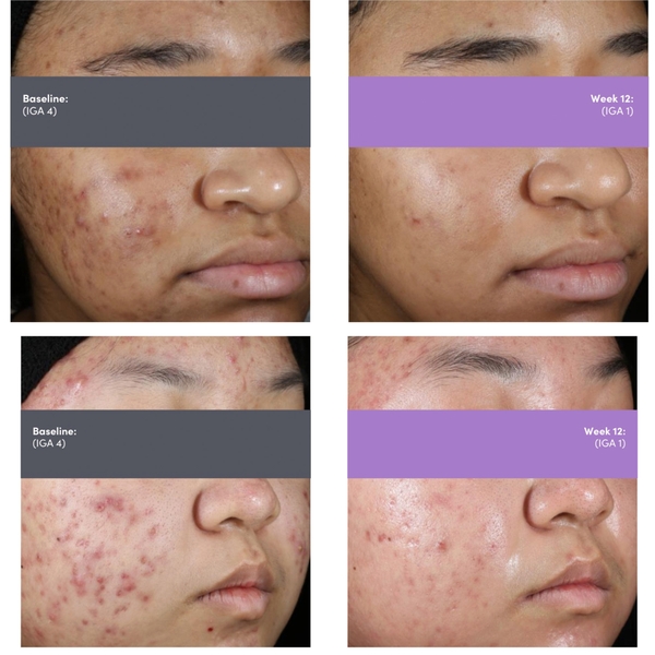 AKLIEF® Trifarotene Cream 0.005% (30g) Retinoid thế hệ mới hỗ trợ điều trị mụn mặt & mụn cơ thể