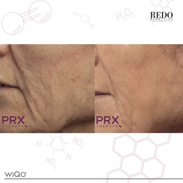 WIQO PRX-T33: Biorevitalization Thế Hệ Mới - Trẻ Hóa Da, Săn Chắc & Sáng Rạng Ngay Lập Tức
