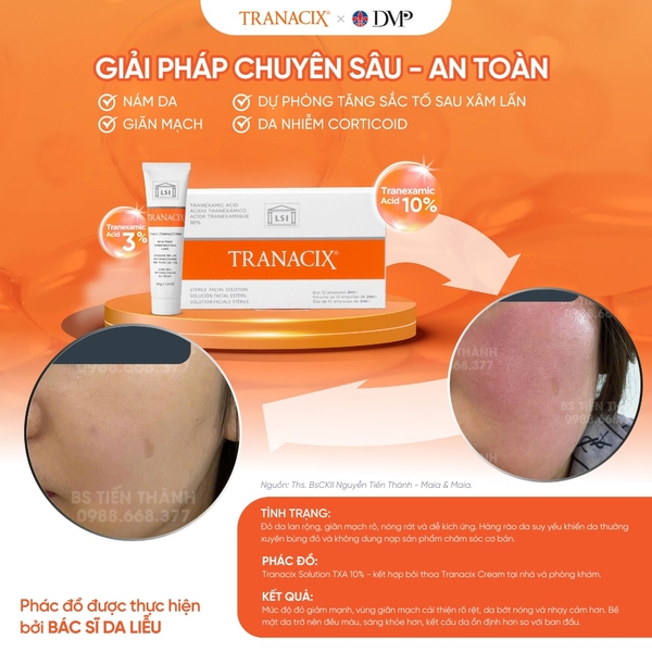 TRANACIX® Sterile Facial Solution – Tinh Chất Tranexamic Acid 10% Làm Mờ Nám & Sắc Tố Chuyên Sâu