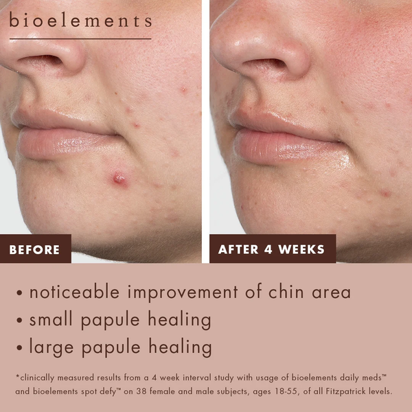 Bioelements Spot Defy – Kem Chấm Mụn Lưu Huỳnh 5% Giúp Giảm Mụn Qua Đêm