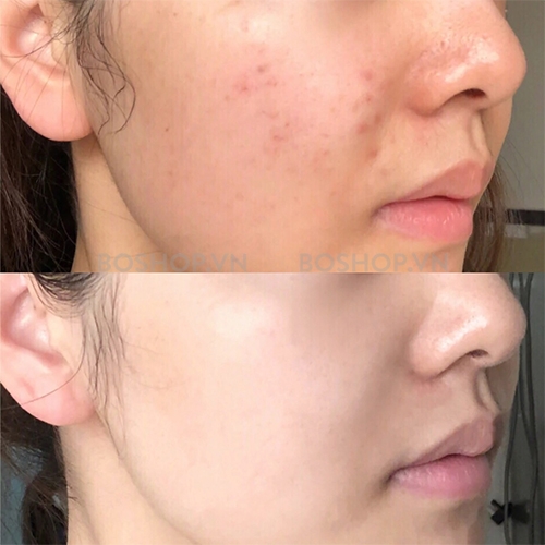 AZCLEAR ACTION AZELAIC ACID 20% 25g / KEM DƯỠNG GIẢM MỤN, MỜ THÂM