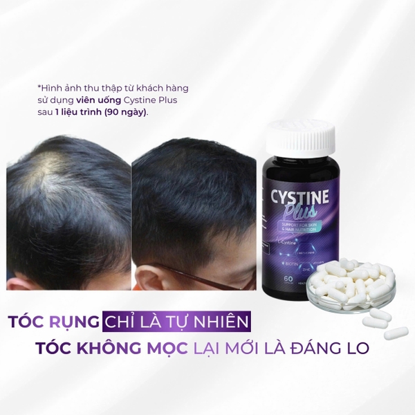 Cystine Plus 60 Viên – Viên uống hỗ trợ giảm mụn, hạn chế rụng tóc và nuôi dưỡng làn da