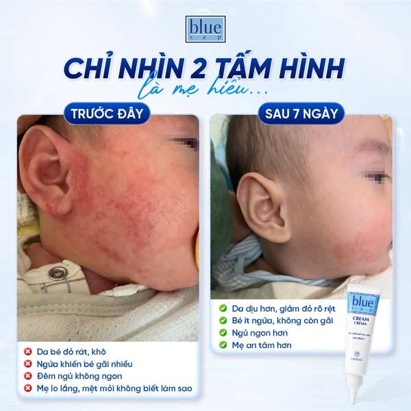 Blue Cap Cream 50g – Kem dưỡng ẩm sâu, hỗ trợ làm dịu da khô và nhạy cảm