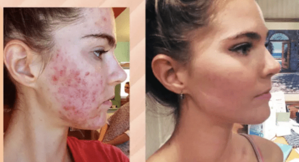 AZELDERM 20% KREM AZELAIC AICD 30g / KEM TRỊ MỤN, LÀM SÁNG VÀ ĐỀU MÀU DA