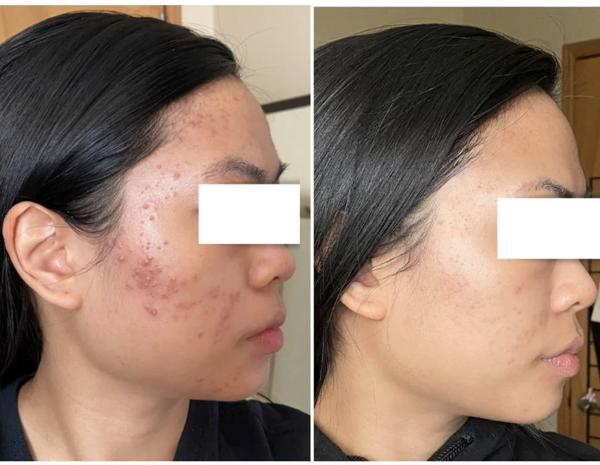 Obagi Tretinoin 0.05% Cream – Kem Dưỡng Hỗ Trợ Giảm Mụn & Cải Thiện Bề Mặt Da Tươi Trẻ