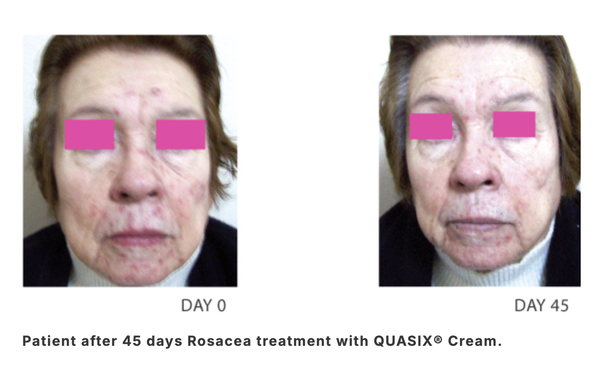 QUASIX GEL 30g / GEL ĐỂ KIỂM SOÁT TÌNH TRẠNG ĐỎ BỪNG MẶT VÀ BỆNH ROSACEA Ở DA NHỜN ( DA DẦU, DA HỖN HỢP) 