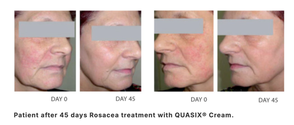 QUASIX CREAM / KEM DƯỠNG CHO LÀN DA ỬNG ĐỎ, ROSACEA (DA KHÔ, DA THƯỜNG)