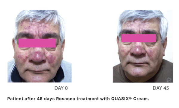 QUASIX CREAM / KEM DƯỠNG CHO LÀN DA ỬNG ĐỎ, ROSACEA (DA KHÔ, DA THƯỜNG)