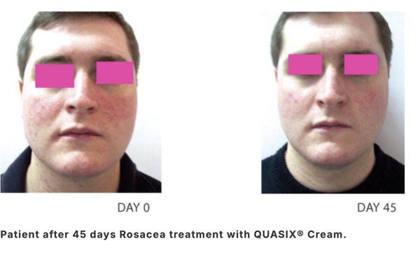 QUASIX CREAM / KEM DƯỠNG CHO LÀN DA ỬNG ĐỎ, ROSACEA (DA KHÔ, DA THƯỜNG)