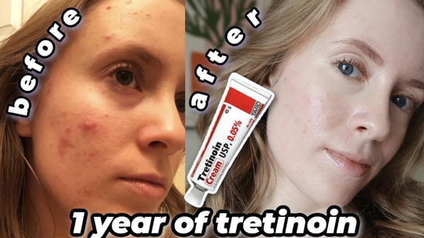 TRETINOIN TARO CREAM USP: Liệu Pháp Đặc Trị Mụn, Nếp Nhăn & Sắc Tố Với Hiệu Quả Đã Được FDA Công Nhận