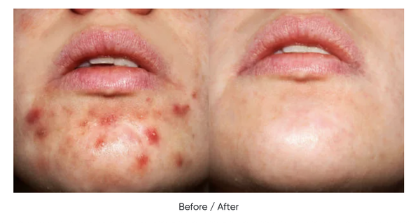 Mineaderm AC-Control Cream – Kem Dưỡng Kiểm Soát Dầu Thừa, Làm Dịu Da Và Ngăn Ngừa Mụn