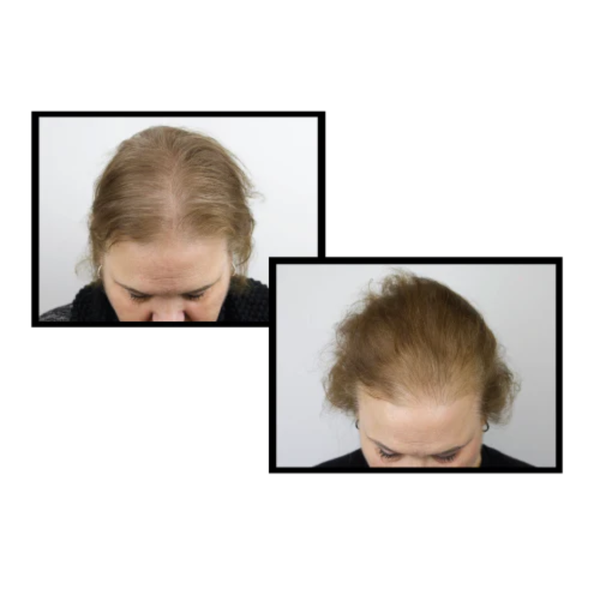 ANTEAGE MD® HAIR SOLUTION / TINH CHẤT GIẢM RỤNG VÀ KÍCH THÍCH MỌC TÓC 