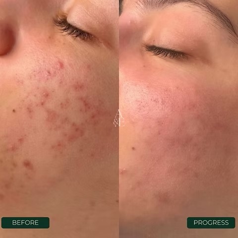 PHARMAFORM SPOT ELIMINATOR ACNE GEL: Gel Chấm Mụn Cấp Tốc - Giảm Mụn, Kiềm Dầu & Mờ Thâm