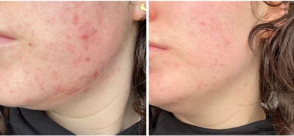 PHARMAFORM ACNE CLARIFYING PLUS SERUM: Tinh Chất Trị Mụn & Chống Lão Hóa Cho Làn Da Trưởng Thành