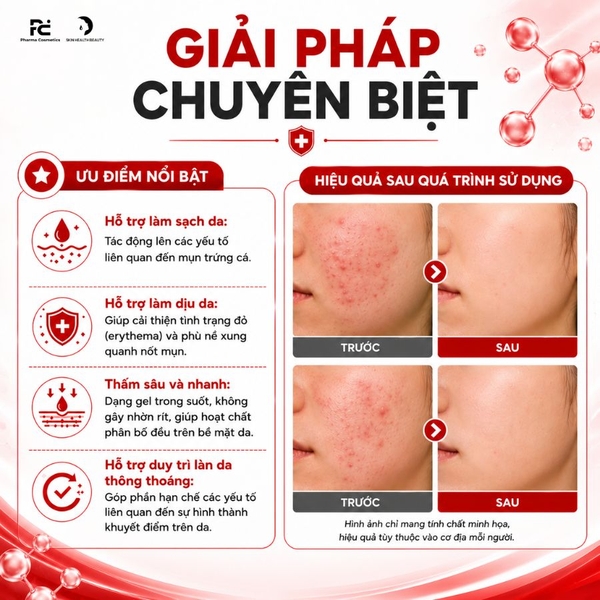 Acnewar Gel 15g: Giải Pháp Kháng Khuẩn, Giảm Sưng Viêm Và Điều Trị Mụn Hiệu Quả