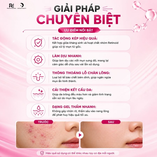 Acnewar Plus Gel 15g: Giải Pháp Đột Phá Cho Mụn Trứng Cá Và Mụn Viêm sưng
