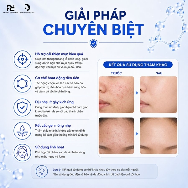 ADAPALENE GEL ADAFERIN 0.1%: Gel Đặc Trị Mụn Ẩn, Mụn Đầu Đen - Cho Làn Da Láng Mịn