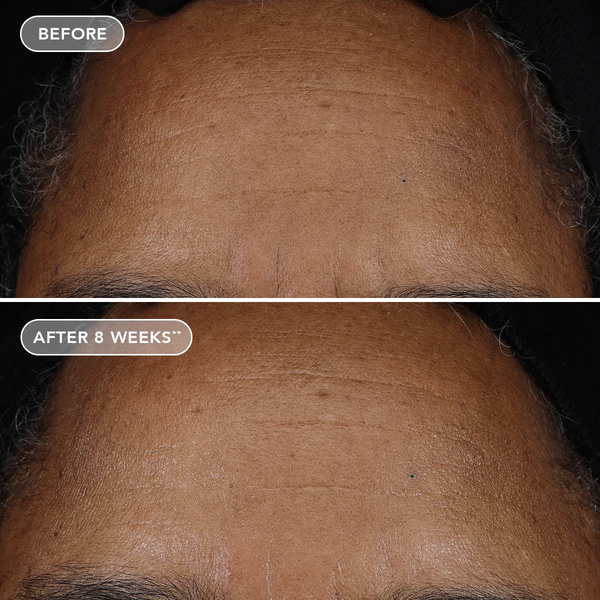 IMAGE Skincare AGELESS+ Retinol Pure Liquid Retinol 0.75% – Serum retinol tinh khiết dành cho người đã sử dụng retinol nồng độ cao da dầu, mụn