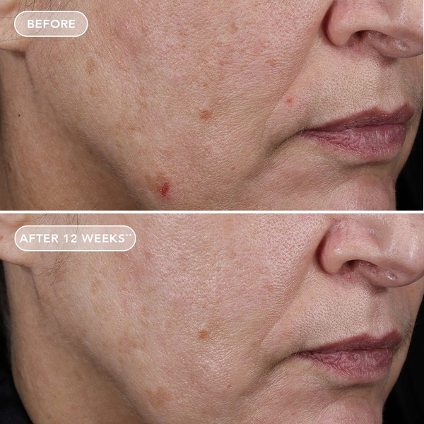 IMAGE Skincare AGELESS+ Retinol Pure Liquid Retinol 0.75% – Serum retinol tinh khiết dành cho người đã sử dụng retinol nồng độ cao da dầu, mụn