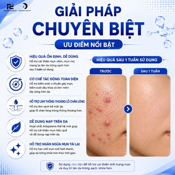 Aldocont B Gel: Giải Pháp Hỗ Trợ Điều Trị Mụn Viêm, Mụn Mủ & Ngăn Ngừa Thâm Sạm Toàn Diện