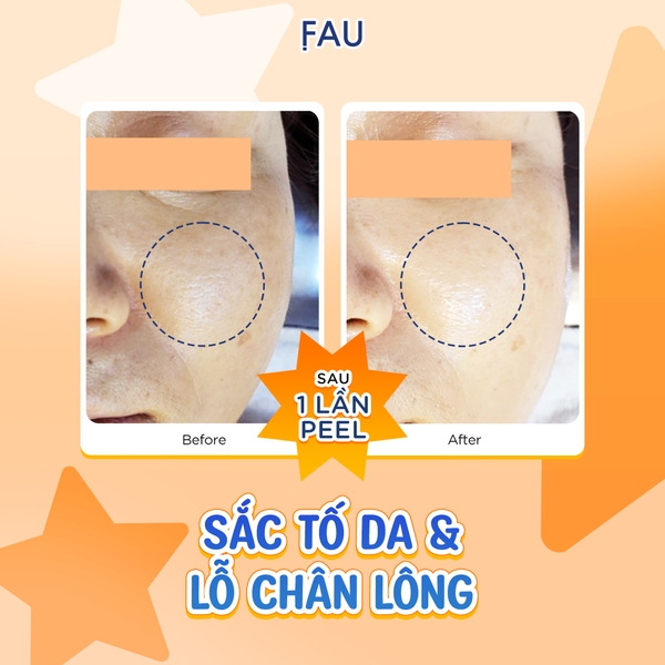 FAU Shiny Pumpkin Peel – Giải Pháp Thay Da Sinh Học Dịu Nhẹ Từ Enzyme Bí Đỏ Đậm Đặc