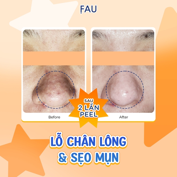 FAU Shiny Pumpkin Peel – Giải Pháp Thay Da Sinh Học Dịu Nhẹ Từ Enzyme Bí Đỏ Đậm Đặc