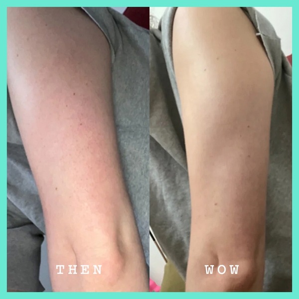 PHARMAFORM SMOOTHING INTENSE MOISTURE BODY LOTION: Sữa Dưỡng Thể Chuyên Sâu - Giảm Viêm Nang Lông & Mụn Lưng