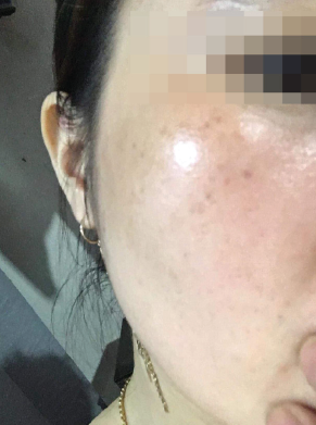 K5 LIPOGEL / KEM TRỊ NÁM, TÀN NHANG, TĂNG SẮC TỐ