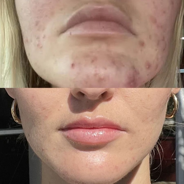 NEOVA MICROFOLIANT CLEANSER (Alpha-Beta-Retinol) / SỮA RỬA MẶT TẨY TẾ BÀO CHẾT, LÀM SẠCH LỖ CHÂN LÔNG