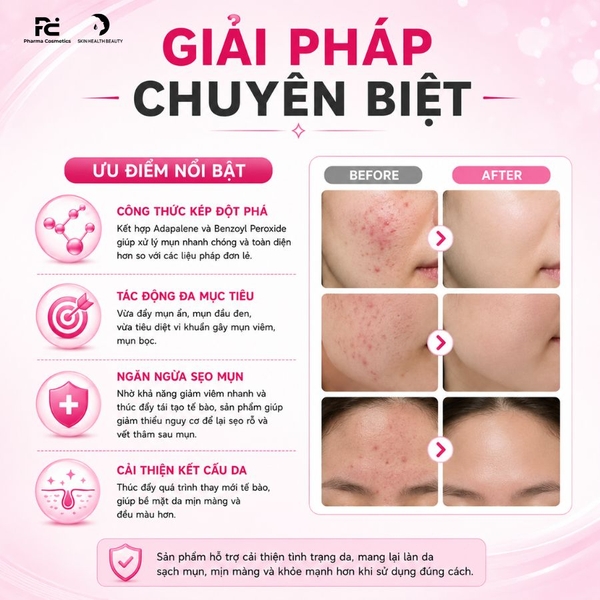 Deriva-BPO Gel: Giải Pháp Giảm Mụn Trứng Cá, Kháng Viêm Và Giải Phóng Lỗ Chân Lông