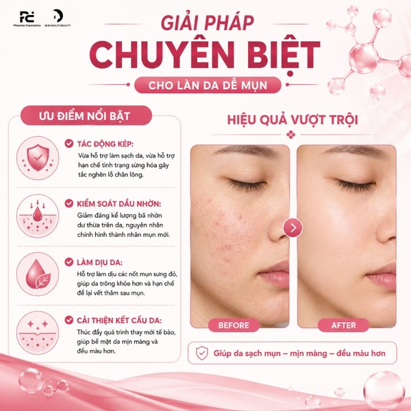 Deriva-CMS Gel: Giải Pháp Giảm Mụn Trứng Cá, Mụn Viêm Và Mụn Ẩn Hiệu Quả
