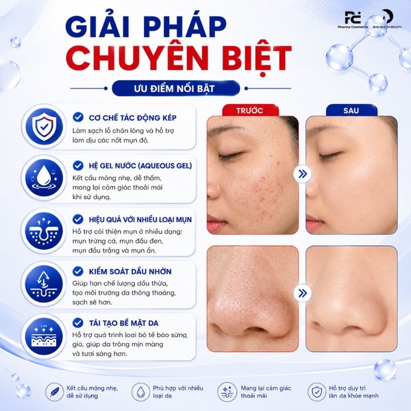 Deriva MS Aqueous Gel: Giải Pháp Trị Mụn Trứng Cá, Mụn Đầu Đen Và Kiểm Soát Dầu Nhờn