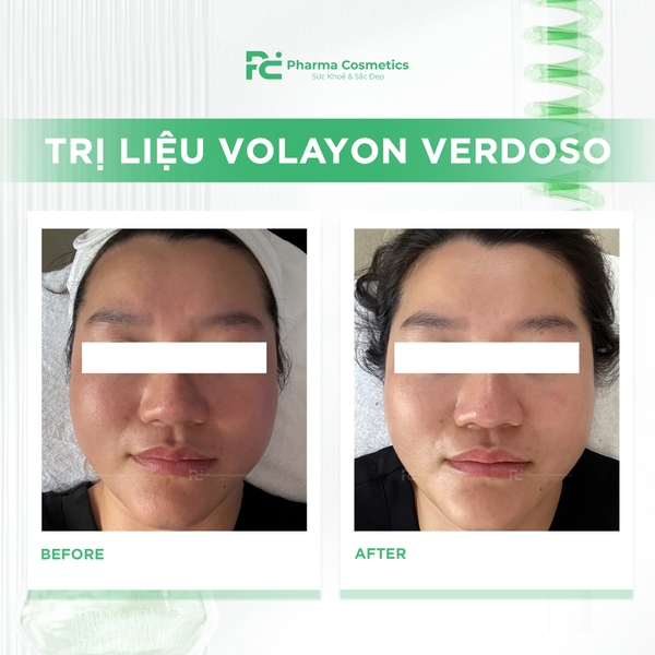 TRỊ LIỆU VOLAYON VERDOSO: Giải Pháp "Giải Nhiệt" và Tái Tạo Toàn Diện Cho Làn Da Nhạy Cảm