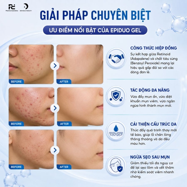 Epiduo ADAPALENE-0.1%W/W+BENZOYL PEROXIDE-2.5%W/W gel: Giải Pháp Hỗ Trợ Cải Thiện Mụn Trứng Cá, Mụn Đầu Đen Và Viêm Da Chuyên Sâu