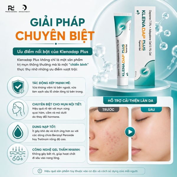 Gel Trị Mụn Klenadap Plus: Giải Pháp "Kép" Cho Mụn Viêm & Mụn Nội Tiết