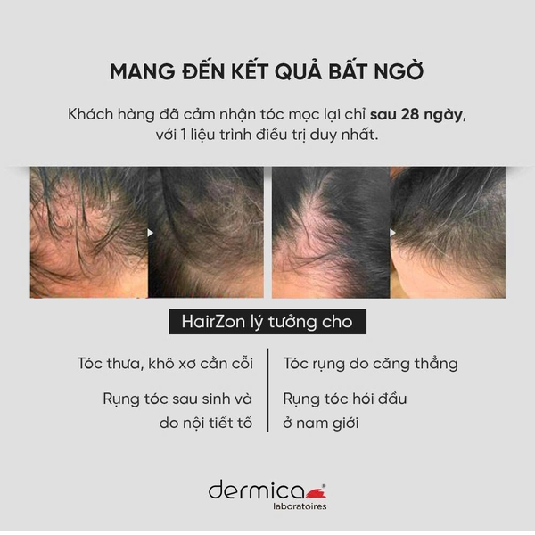 DERMICA HairZon – Tinh Chất Dưỡng Tóc Giải Pháp Hỗ Trợ Giảm Rụng Tóc, Kích Thích Tóc Trông Dày Và Bồng Bềnh Hơn