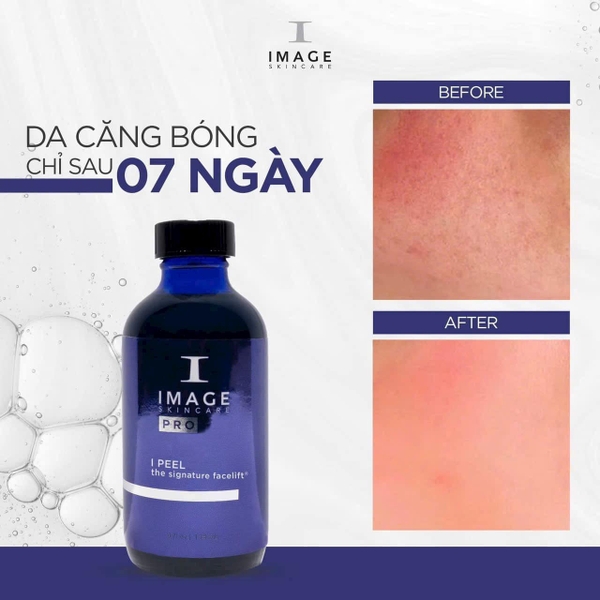 SIGNATURE FACELIFT®: Phục Hồi Làn Da Nhạy Cảm, Mụn Viêm, Da Khô, Mất Nước Giãn Mao Mạch