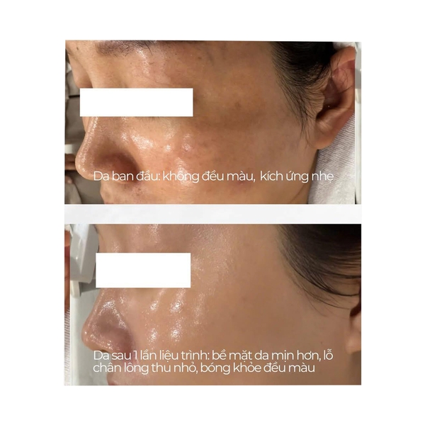 RESURFACE²: Liệu Trình Peel Tái Tạo Tế Bào & Trẻ Hóa Chuyên Sâu Từ Ý