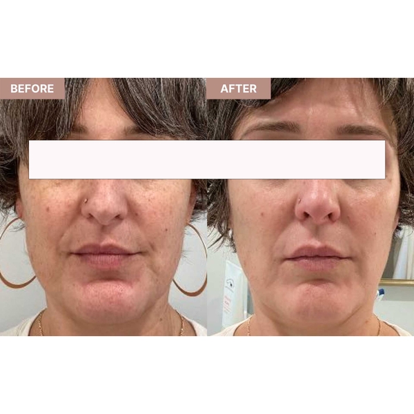 TRETINOIN CREAM, USP PADAGIS: Giải Pháp Chuyên Sâu Cho Mụn, Thâm & Lão Hóa Da