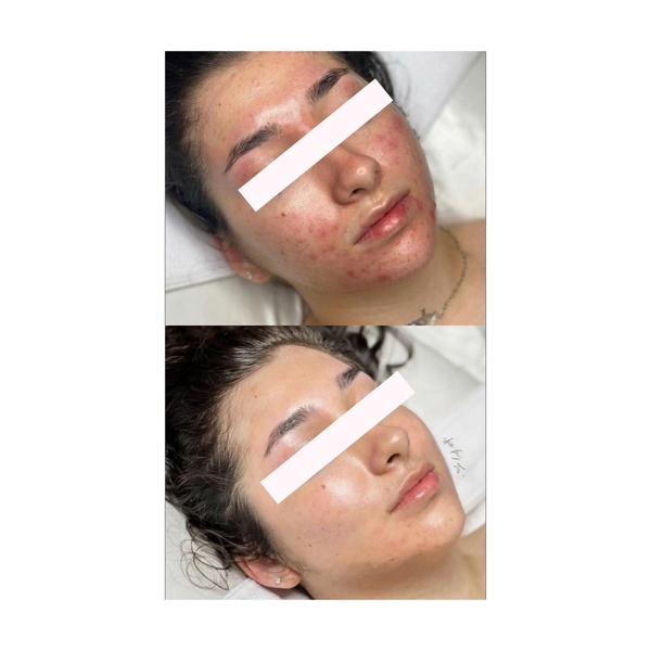 SIGNATURE FACELIFT®: Phục Hồi Làn Da Nhạy Cảm, Mụn Viêm, Da Khô, Mất Nước Giãn Mao Mạch