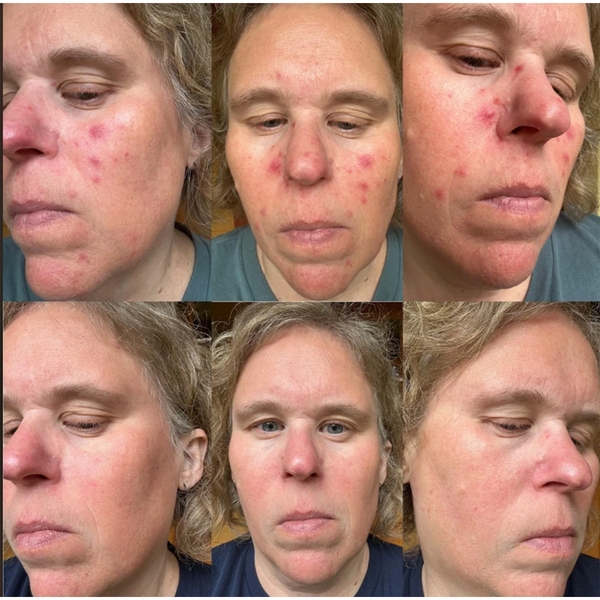 Roza 0,75% Metronidazol: Giải Pháp Đặc Trị Chứng Đỏ Mặt Rosacea Và Viêm Da Demodex