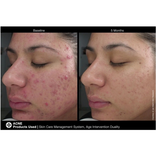 Jan Marini Age Intervention® Duality™ – Kem Dưỡng Buồng Đôi Hỗ Trợ Giảm Mụn Và Ngăn Ngừa Lão Hóa Chuyên Sâu
